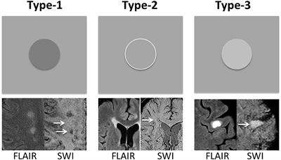 Blood Perfusion and Cellular Microstructural Changes Associated With Iron Deposition in Multiple Sclerosis Lesions